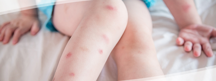 Why Can't We Feel Bed Bug Bites?