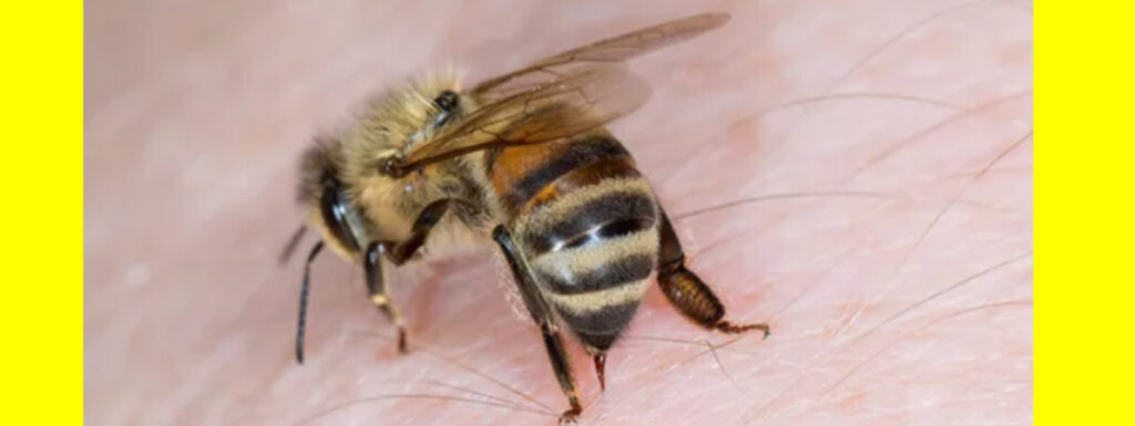 Bee sting